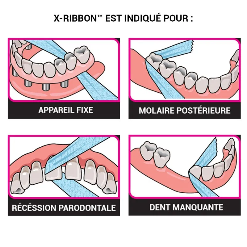 X-Ribbon